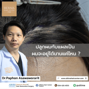 ปลูกผมทับแผลเป็น ผมจะอยู่ได้นานแค่ไหน