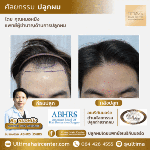 ต้องเลือกแพทย์ปลูกผมอย่างไร หากต้องการผลลัพธ์หลังปลูกผมที่ดี