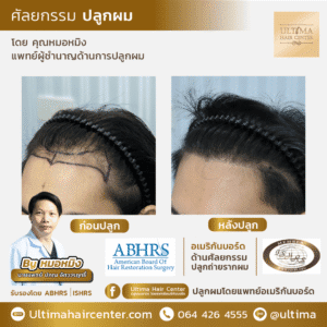 รีวิวปลูกผมผู้ชายใน Pantip น่าเชื่อถือจริงไหม