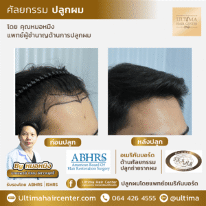 รีวิวปลูกผมผู้ชายใน Pantip น่าเชื่อถือจริงไหม