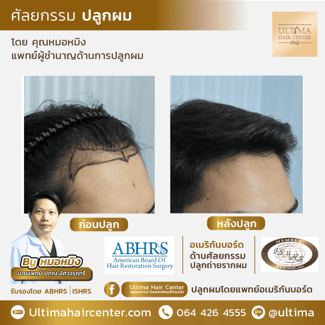 รีวิวปลูกผมผู้ชายใน Pantip น่าเชื่อถือจริงไหม