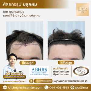 หลังปลูกผม ควรนอนอย่างไร