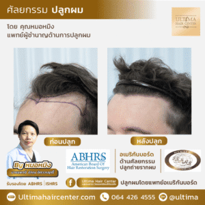 คลินิกปลูกผม ราคา