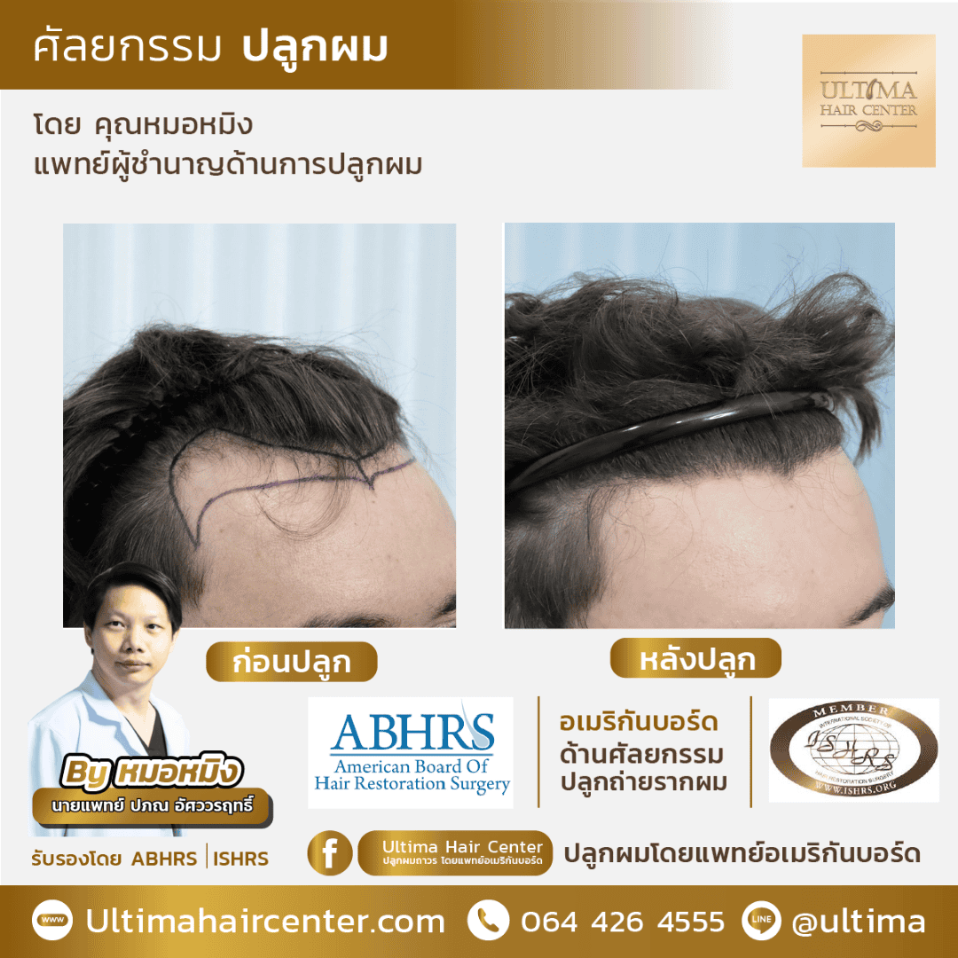 ผมร่วงเยอะมากเกิดจากอะไร ในผู้ชาย ผมร่วงเยอะมากเกิดจากอะไร ในผู้ชาย