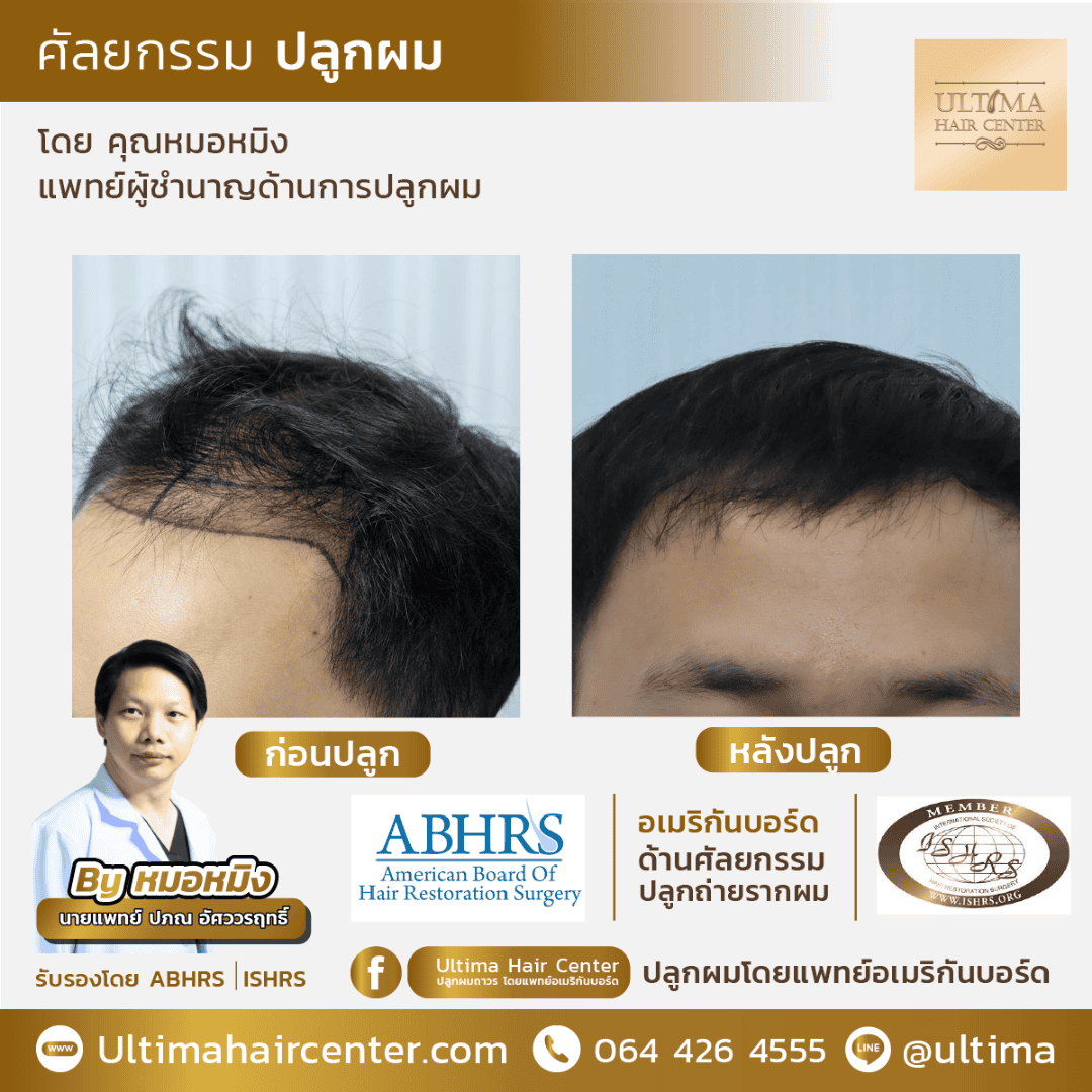 ผมร่วงเยอะมากเกิดจากอะไร ในผู้ชาย