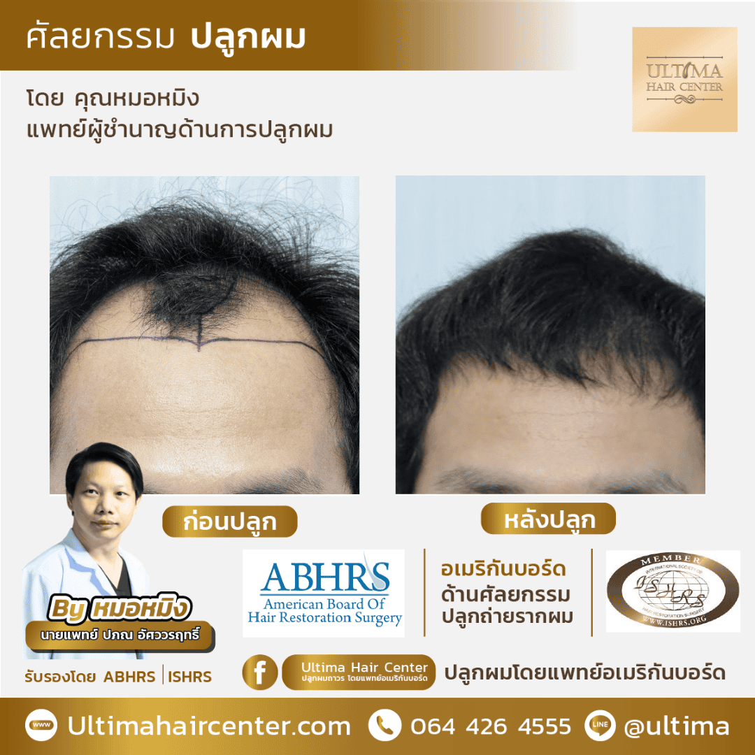 ผมร่วงเยอะมากเกิดจากอะไร ในผู้ชาย