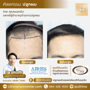 ต้องเลือกแพทย์ปลูกผมอย่างไร หากต้องการผลลัพธ์หลังปลูกผมที่ดี