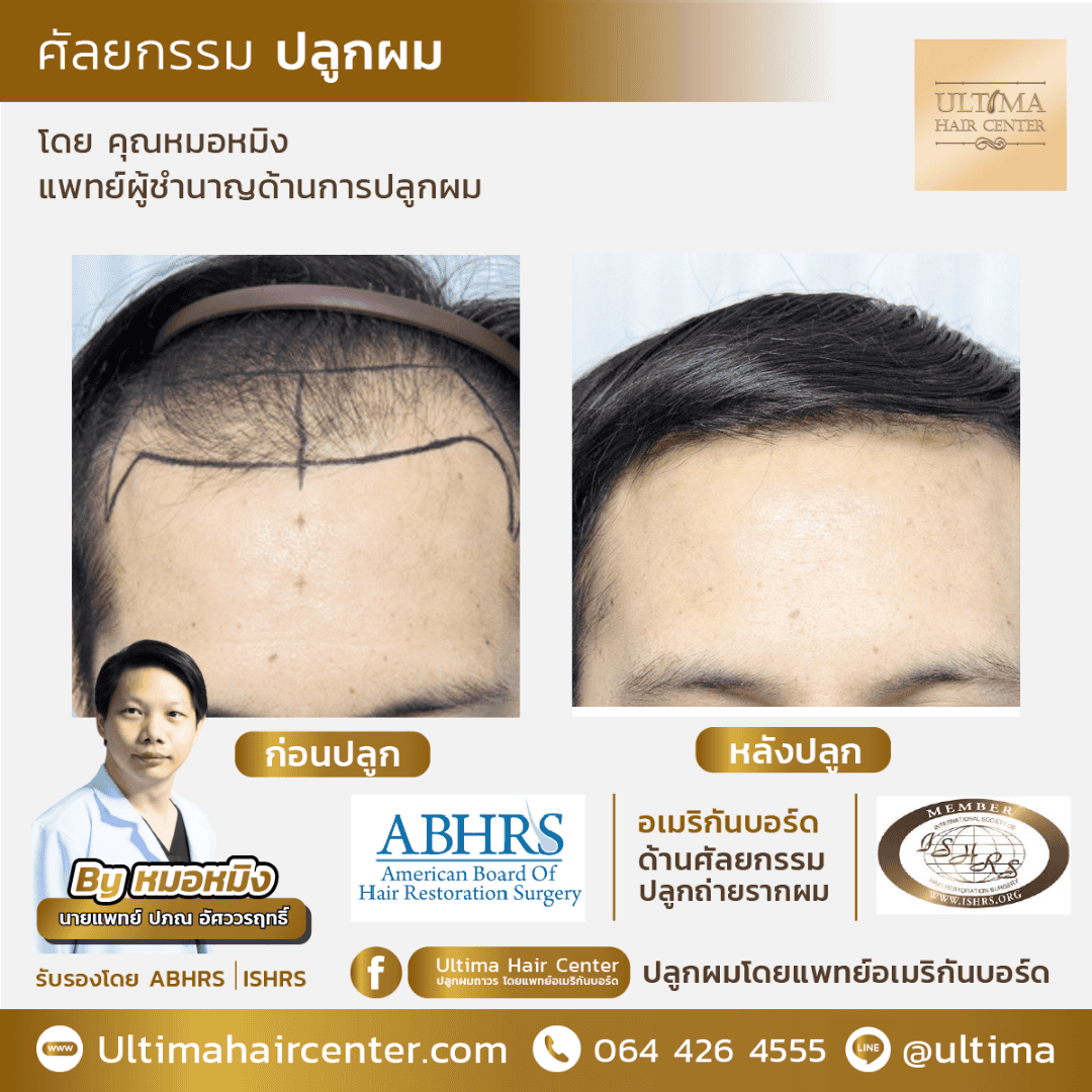 9 วิธีดูแลตัวเองหลังปลูกผม