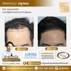 ต้องเลือกแพทย์ปลูกผมอย่างไร หากต้องการผลลัพธ์หลังปลูกผมที่ดี