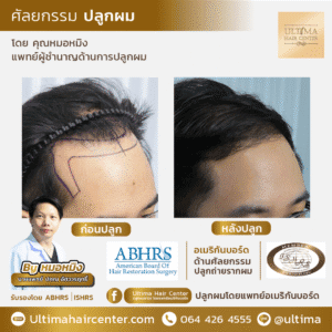 การปลูกผม ปัจจัยใดที่จะทำให้ได้ผลลัพธ์ที่ดีที่สุด