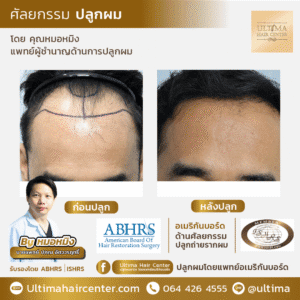 ต้องเลือกแพทย์ปลูกผมอย่างไร หากต้องการผลลัพธ์หลังปลูกผมที่ดี