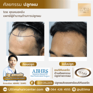 ต้องเลือกแพทย์ปลูกผมอย่างไร หากต้องการผลลัพธ์หลังปลูกผมที่ดี