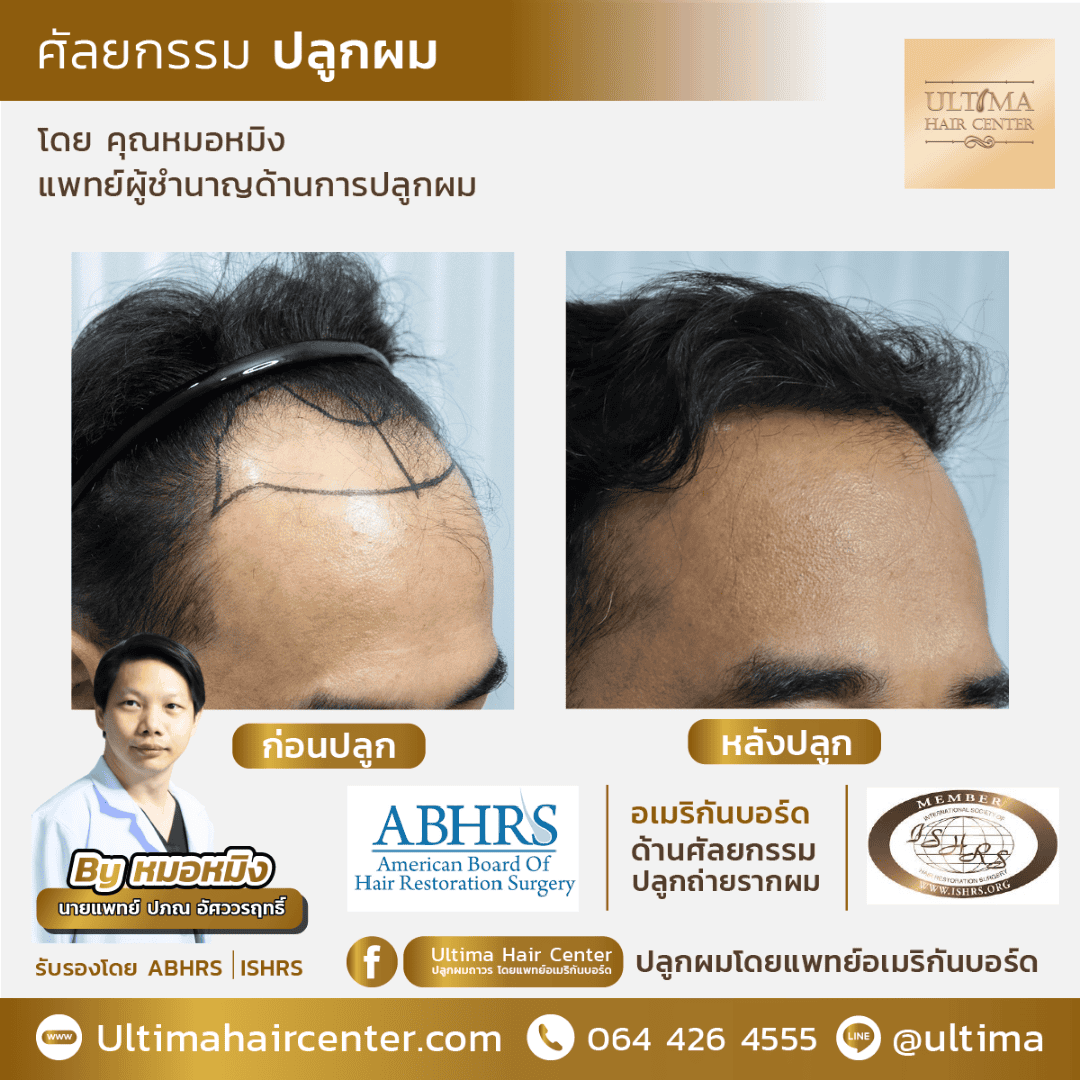 ศัลยกรรมปลูกผมครั้งที่ 2