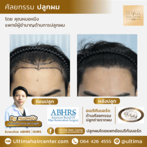 ต้องเลือกแพทย์ปลูกผมอย่างไร หากต้องการผลลัพธ์หลังปลูกผมที่ดี