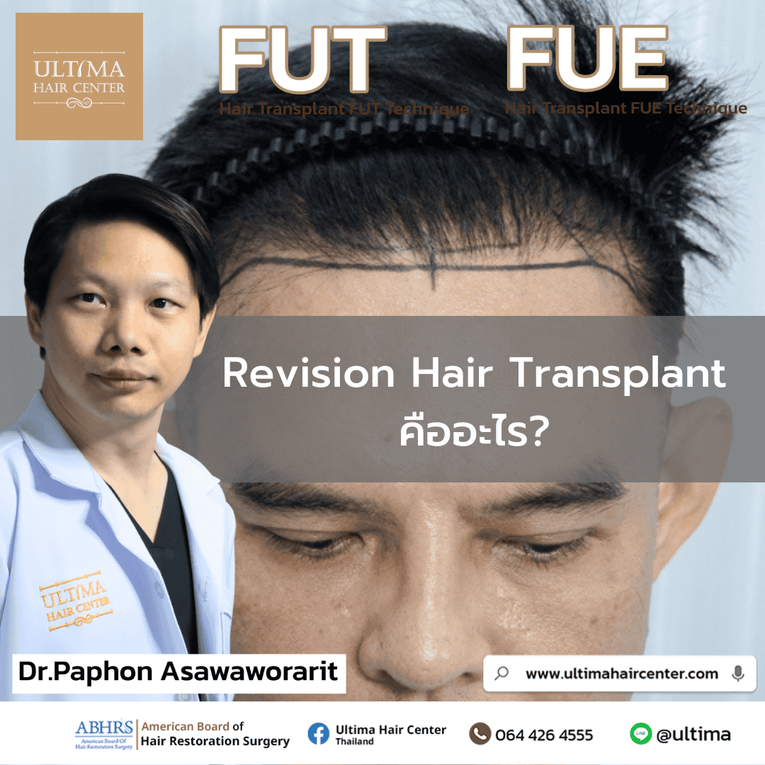 Revision Hair Transplant คือ 