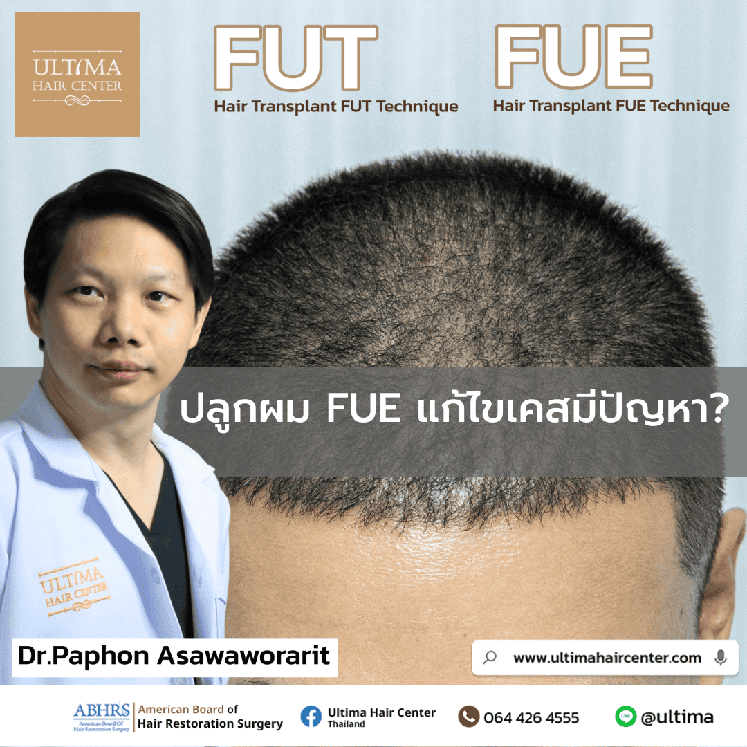 ปลูกผม FUE แก้ไขเคสมีปัญหา