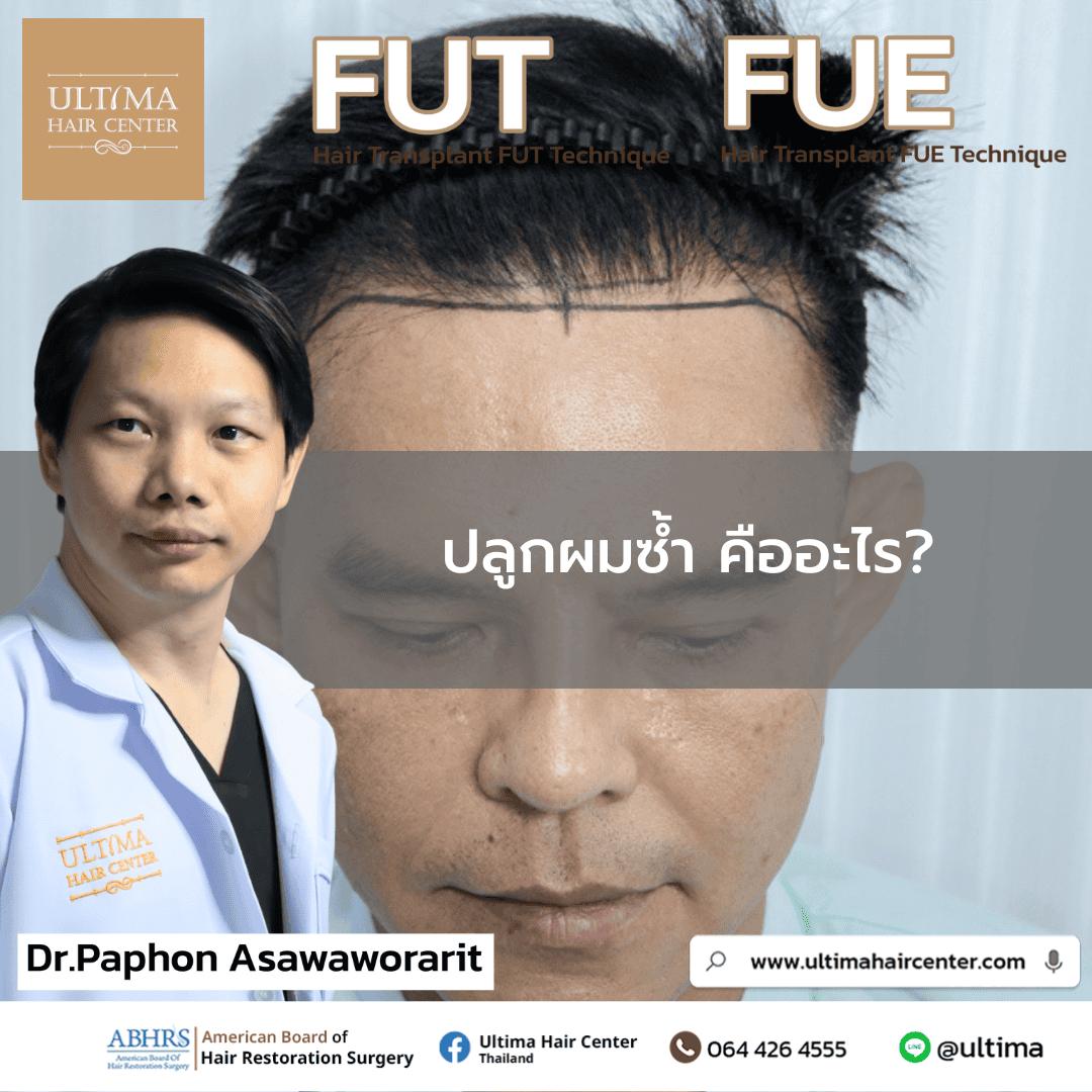 ปลูกผมซ้ำ คืออะไร 