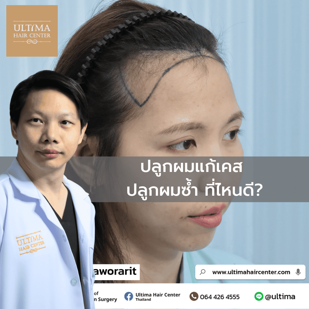 ปลูกผมไม่ขึ้น 