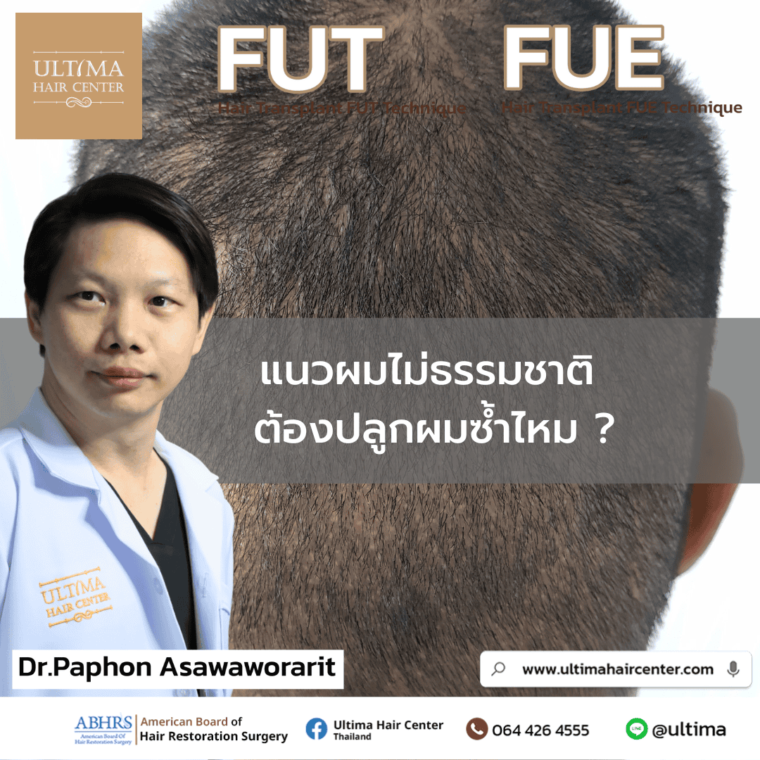 แนวผมไม่ธรรมชาติ ต้องปลูกผมซ้ำไหม