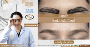 ปลูกคิ้วโดยไม่ผ่าตัดได้ไหม