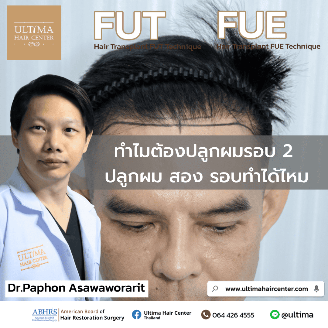 ทำไมต้องปลูกผมรอบ 2 ปลูกผม สอง รอบทำได้ไหม? 