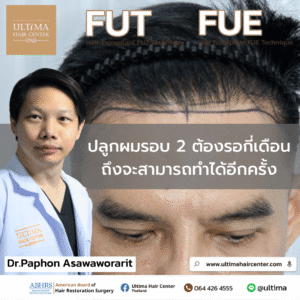 ปลูกผมรอบ 2 ต้องรอกี่เดือนถึงจะสามารถทำได้อีกครั้ง
