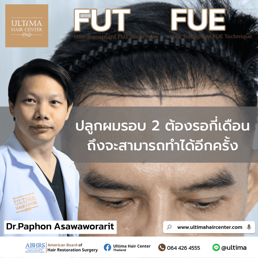 ปลูกผมรอบ 2 ต้องรอกี่เดือนถึงจะสามารถทำได้อีกครั้ง