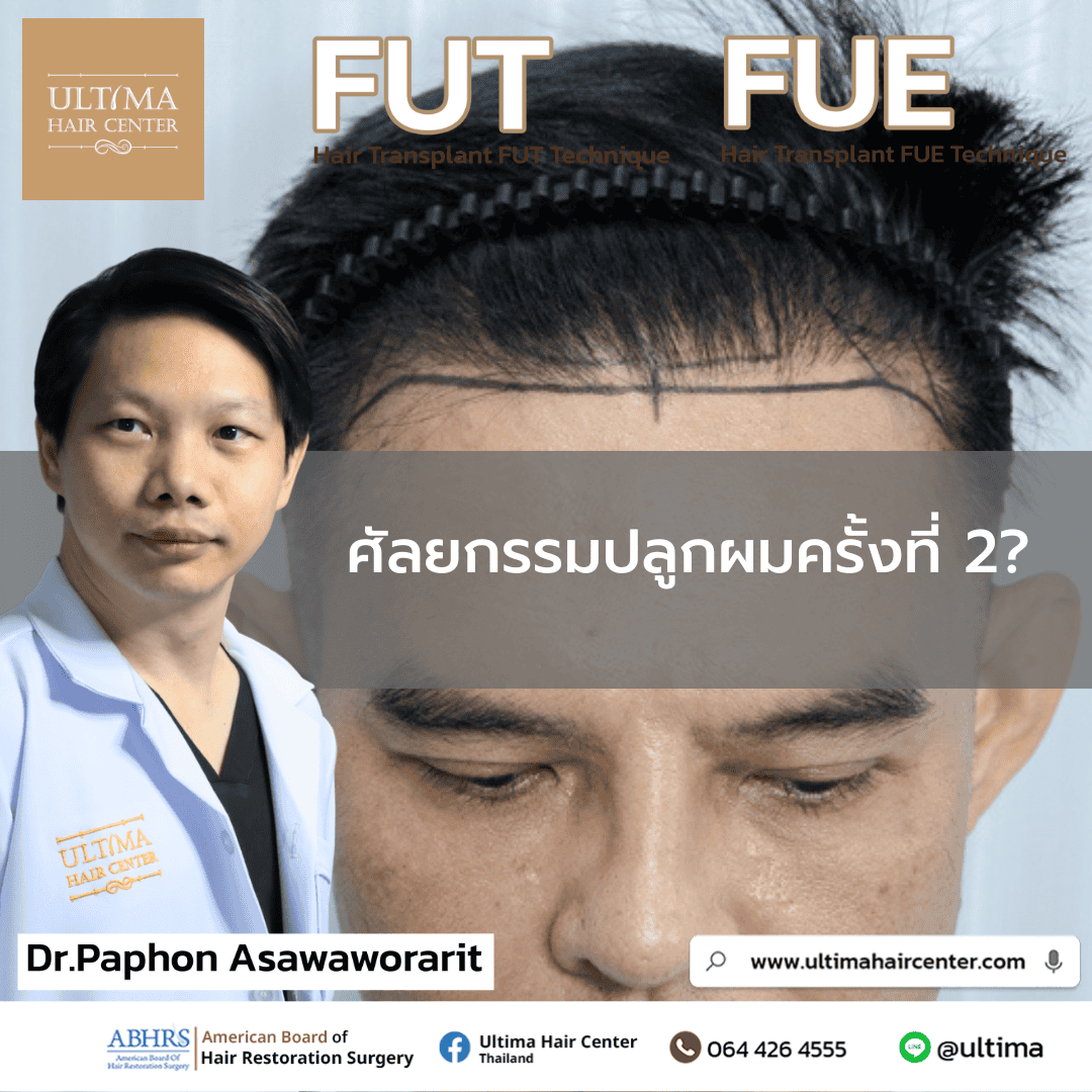 ศัลยกรรมปลูกผมครั้งที่ 2