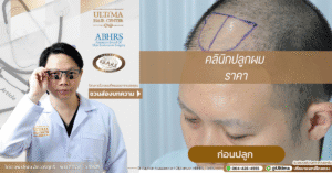 คลินิกปลูกผม ราคา