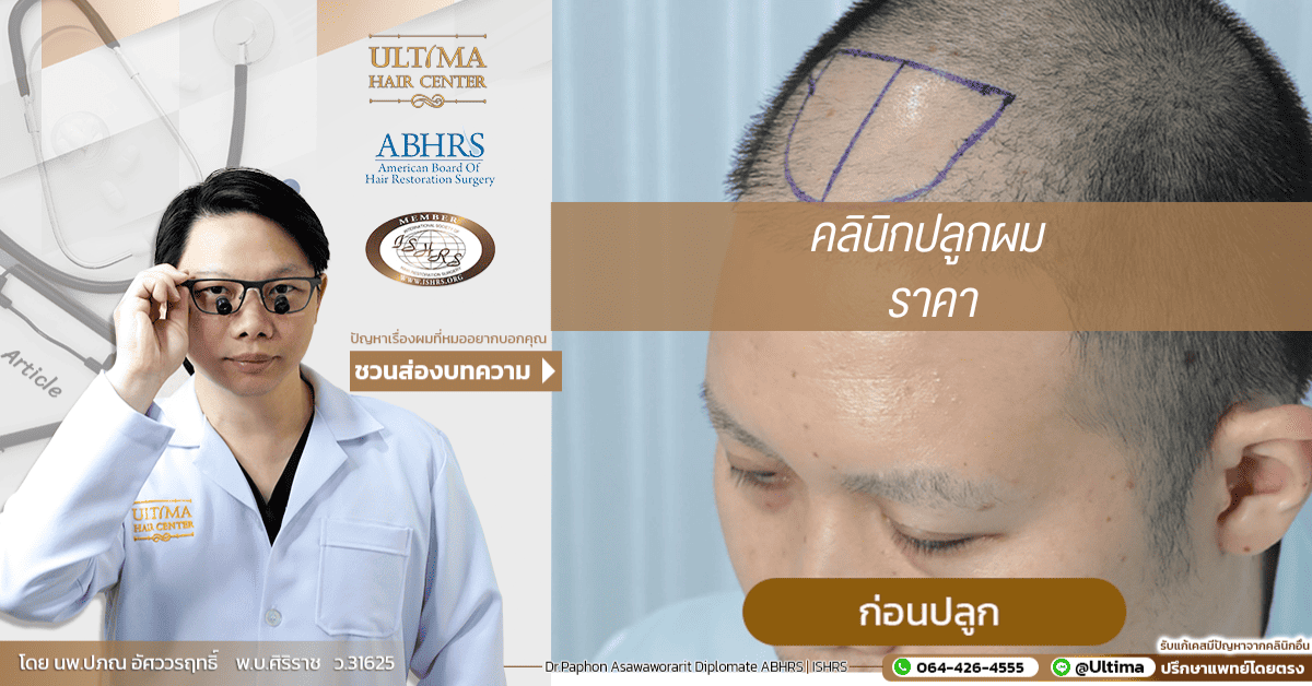 คลินิกปลูกผม ราคา