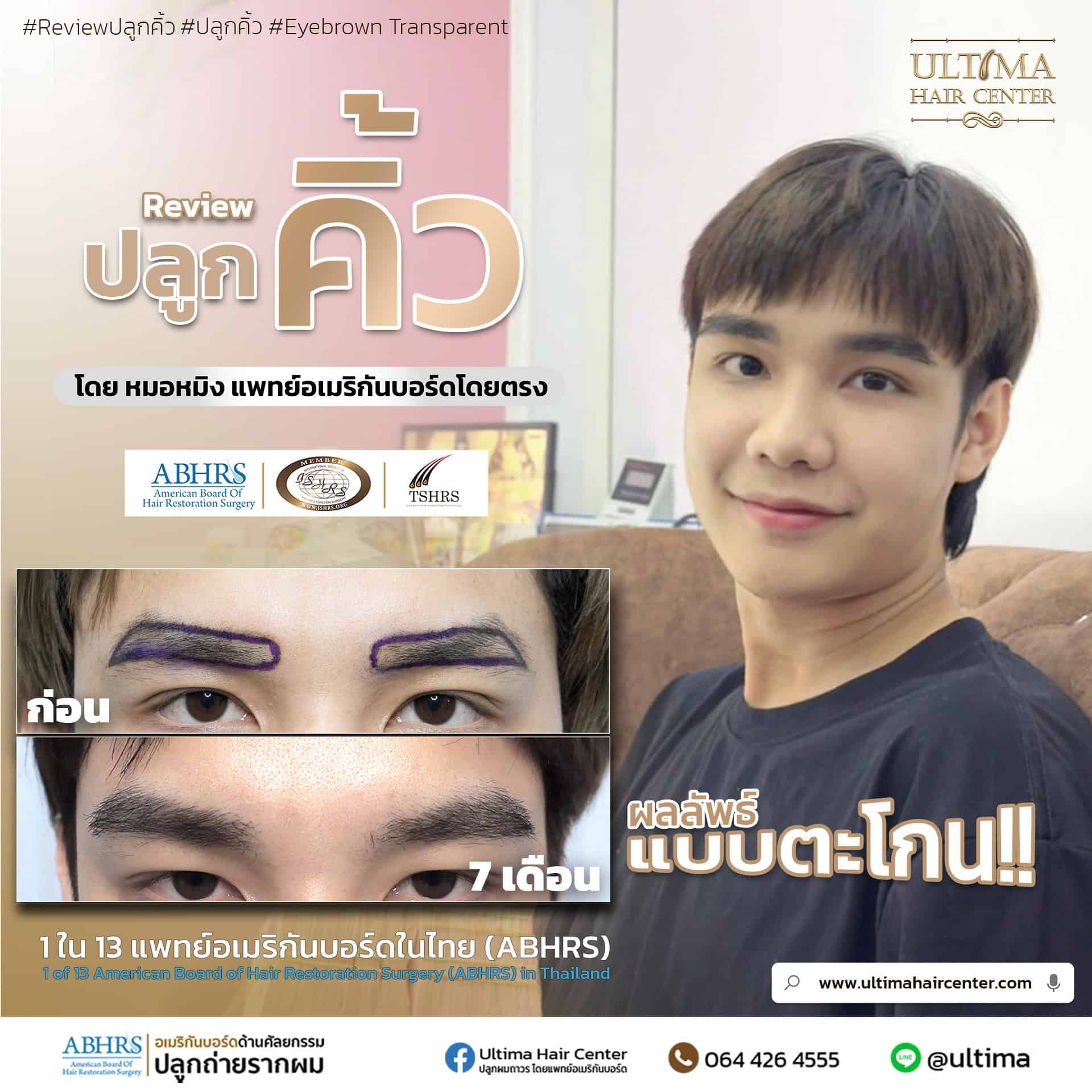 ปลูกคิ้วแล้วออกกำลังกายได้เมื่อไร ปลูกคิ้วแล้วออกกำลังกายได้เมื่อไร