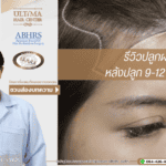 รีวิวปลูกผม หลังปลูก 9-12 เดือน