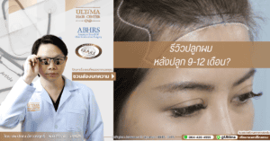 รีวิวปลูกผม หลังปลูก 9-12 เดือน