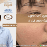 ปลูกคิ้วแก้ปัญหาคิ้วบางจากสาเหตุอะไรได้บ้าง