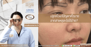 ปลูกคิ้วแก้ปัญหาคิ้วบางจากสาเหตุอะไรได้บ้าง