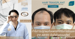 ทำไมการปลูกผมกับแพทย์ที่ได้รับการรับรองจาก ABHRS จึงสำคัญต่อผลลัพธ์
