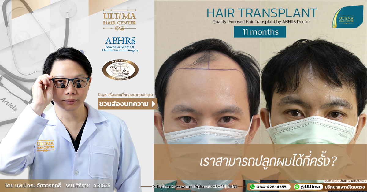 ทำไมการปลูกผมกับแพทย์ที่ได้รับการรับรองจาก ABHRS จึงสำคัญต่อผลลัพธ์ ทำไมการปลูกผมกับแพทย์ที่ได้รับการรับรองจาก ABHRS จึงสำคัญต่อผลลัพธ์
