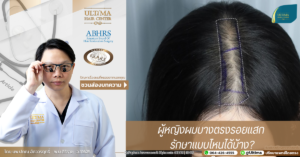 ผู้หญิงผมบางตรงรอยแสก รักษาแบบไหนได้บ้าง