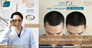 อายุ 20 ต้น ๆ แต่ผมเริ่มบาง ทำอย่างไรดี