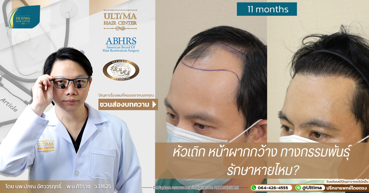 หัวเถิก หน้าผากกว้าง ทางกรรมพันธุ์ รักษาหายไหม