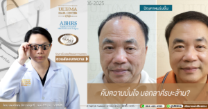 คืนความมั่นใจ บอกลาศีรษะล้าน
