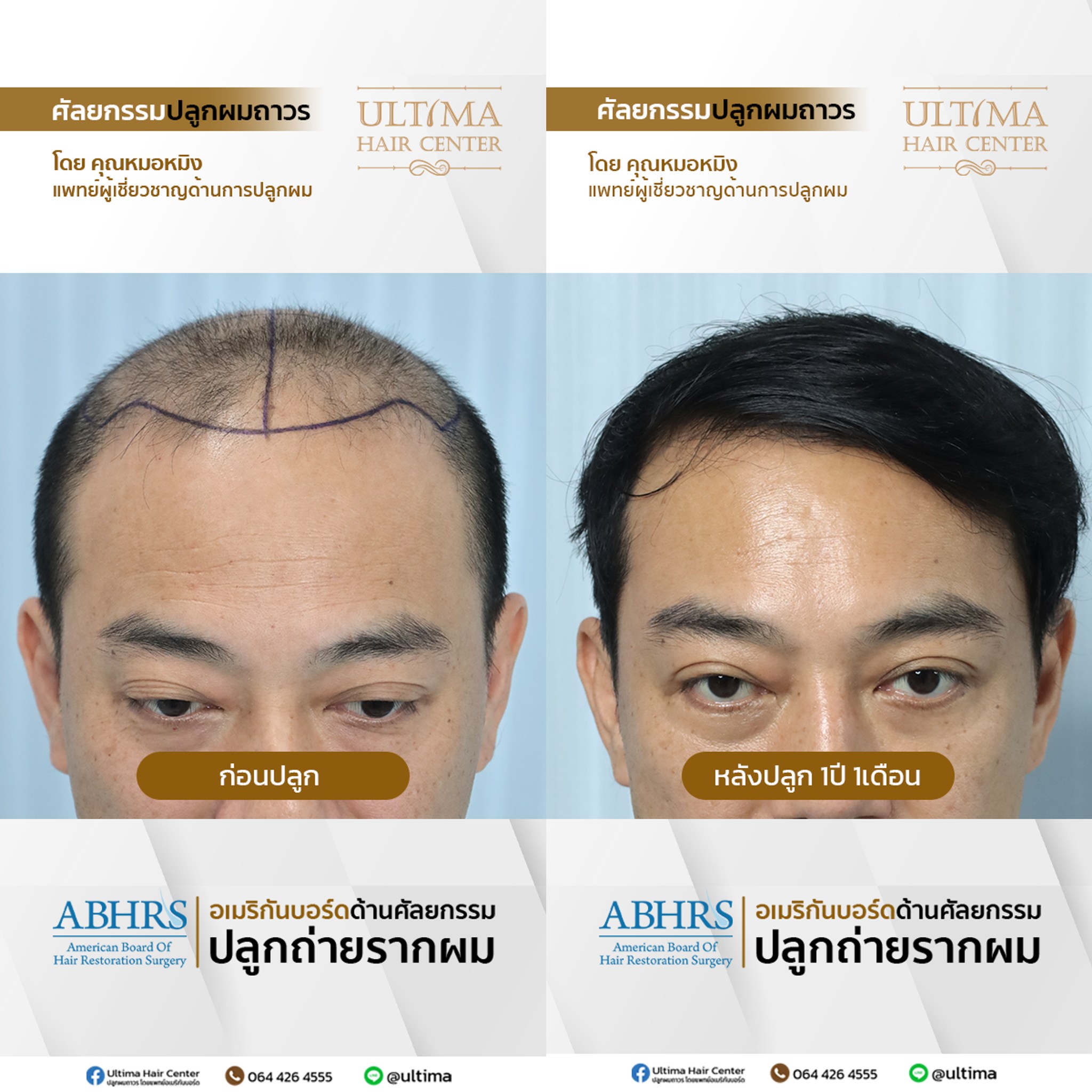 ปลูกผมกี่วันถึงสระผมได้ ปลูกผมกี่วันถึงสระผมได้