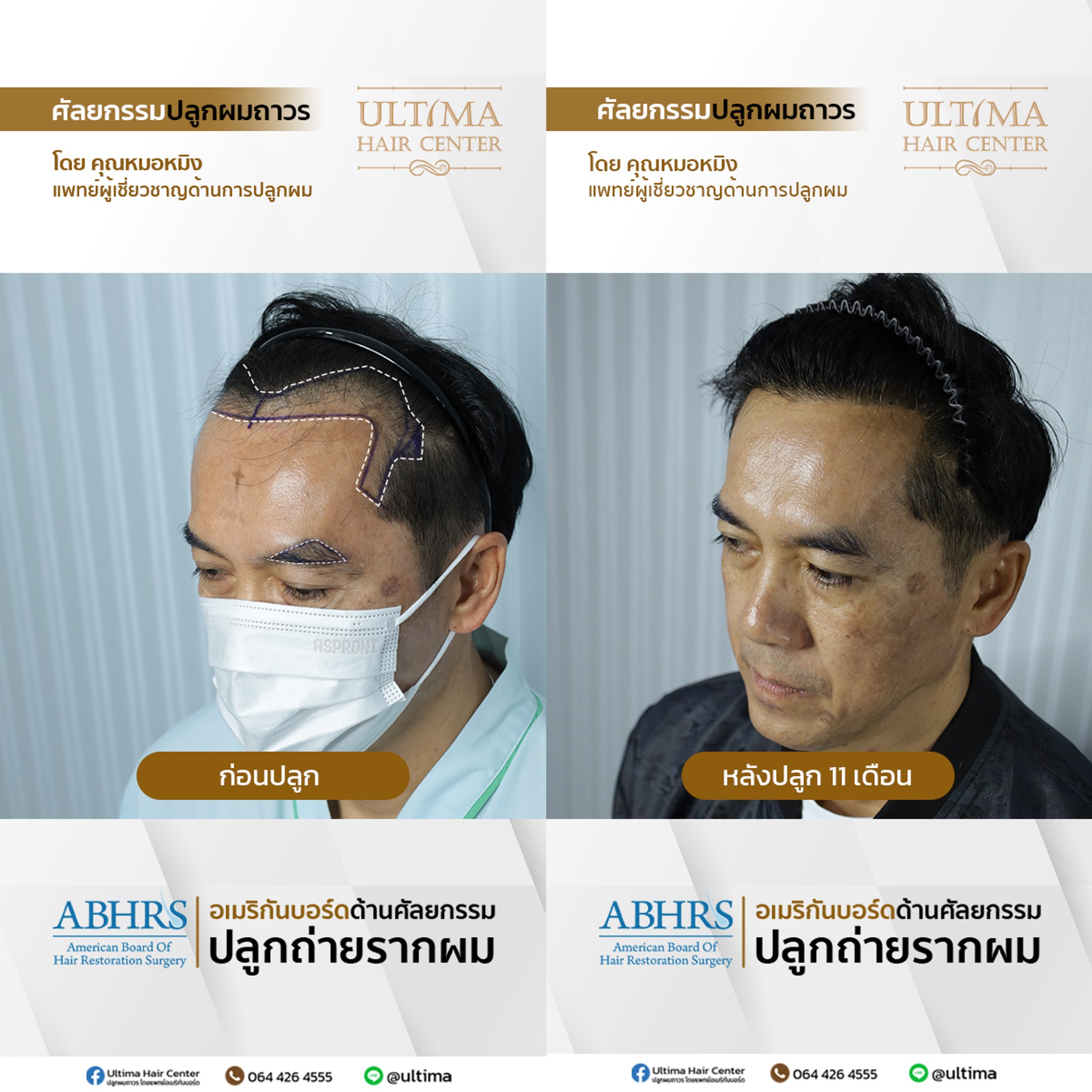 คืนความมั่นใจ บอกลาศีรษะล้าน