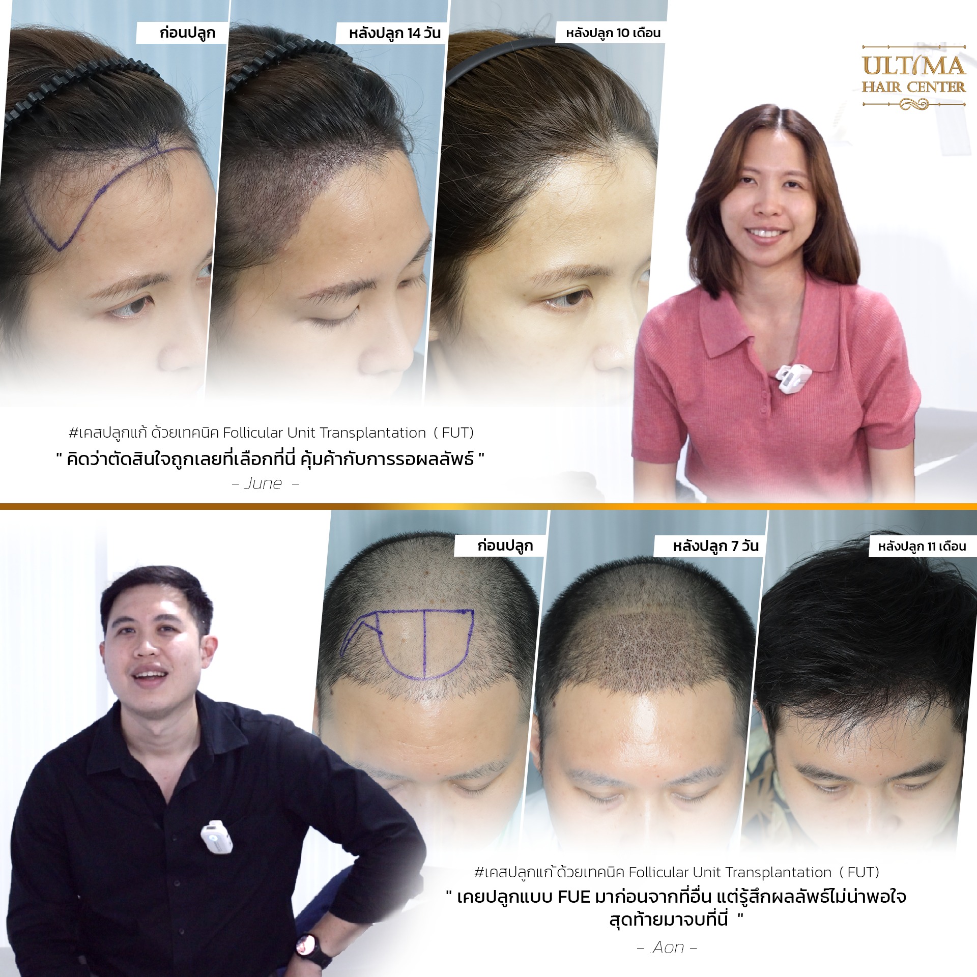 คืนความมั่นใจ บอกลาศีรษะล้าน