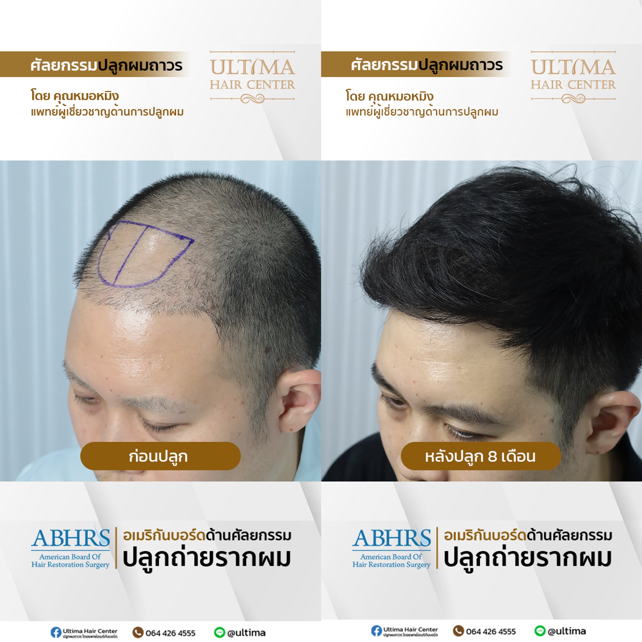 ปลูกผมกี่วันถึงสระผมได้