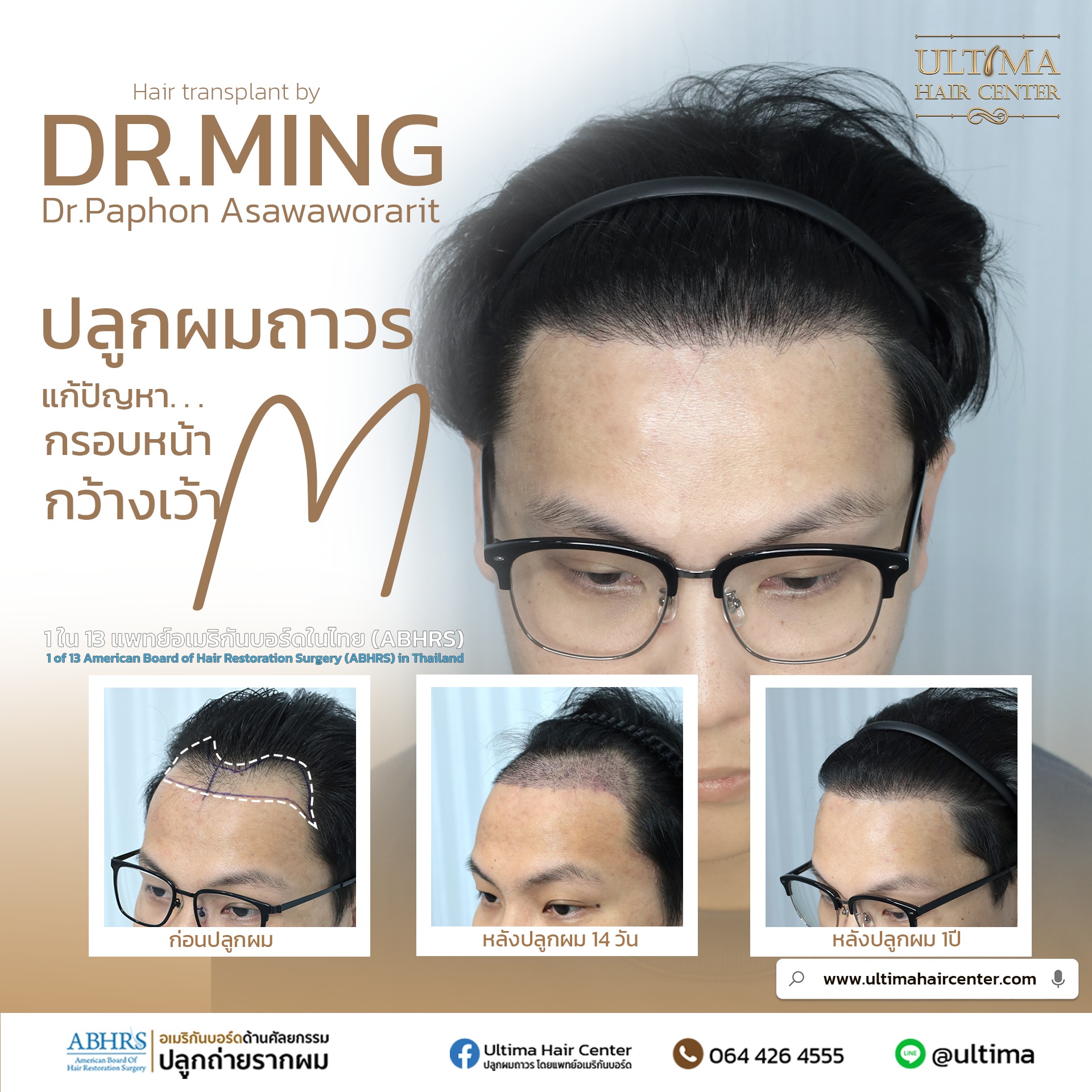 ปลูกผมกี่วันถึงสระผมได้ ปลูกผมกี่วันถึงสระผมได้