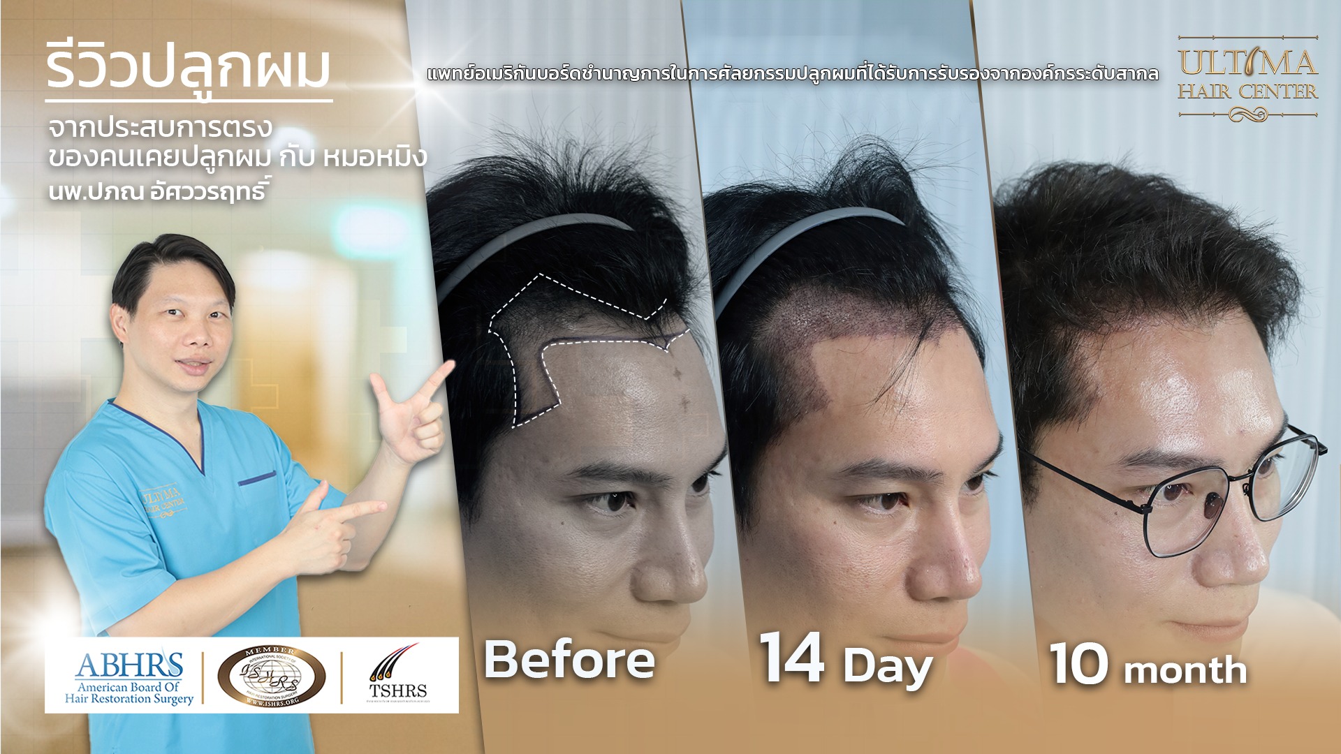 ความแตกต่างของเส้นผมระหว่างชาวเอเชียและชาวยุโรป