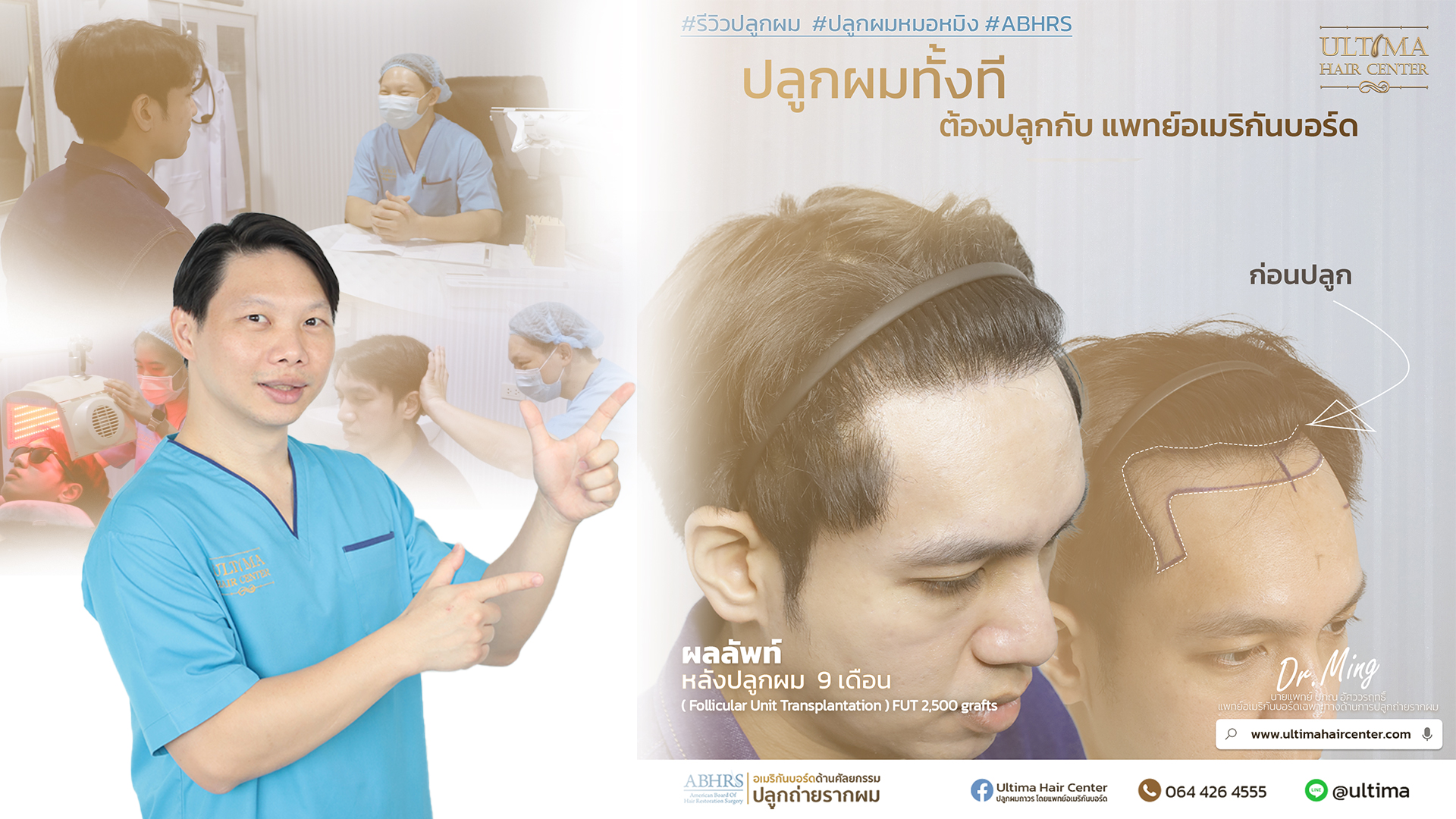 ปลูกผมกี่วันถึงสระผมได้ ปลูกผมกี่วันถึงสระผมได้