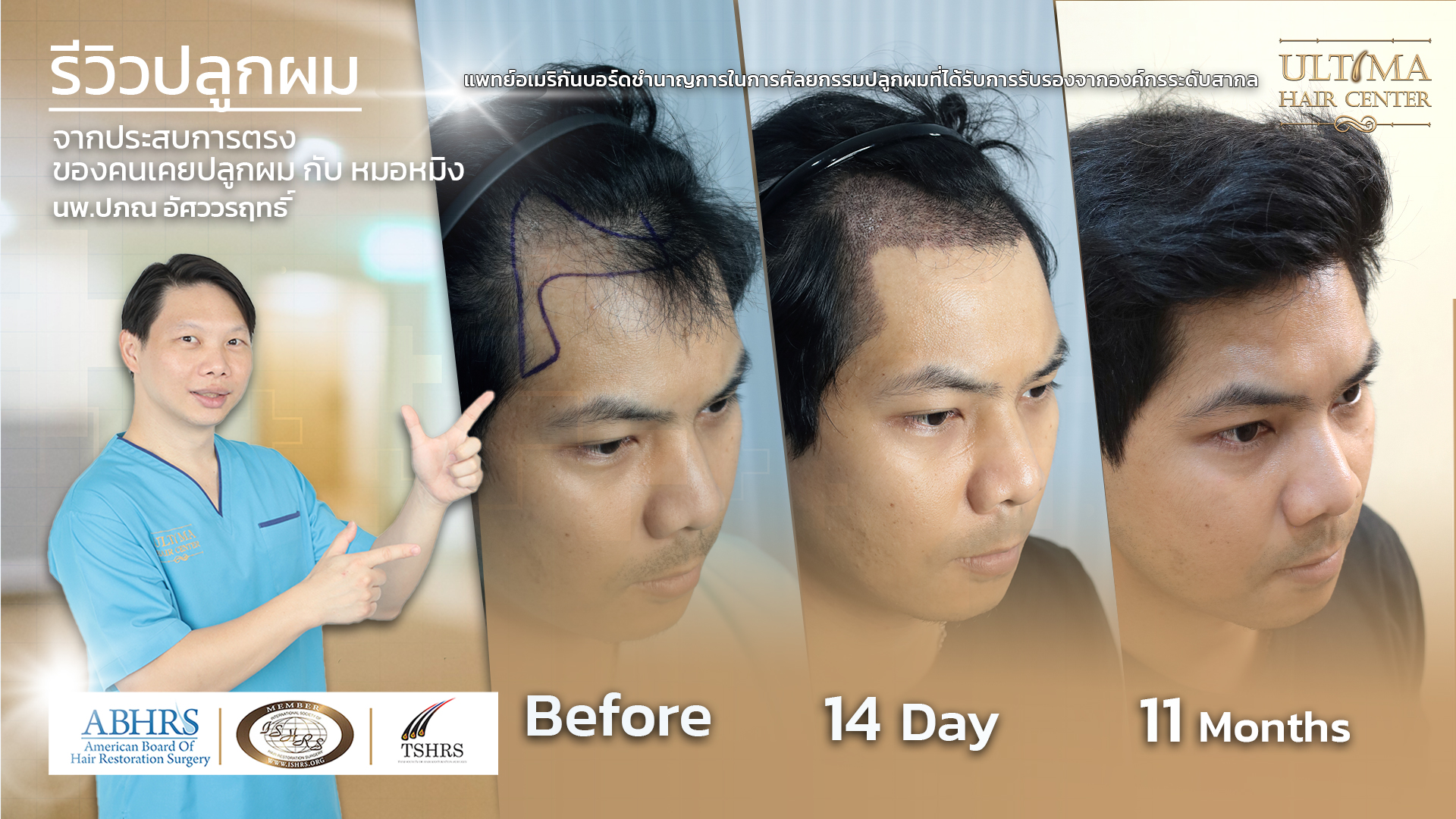 คืนความมั่นใจ บอกลาศีรษะล้าน