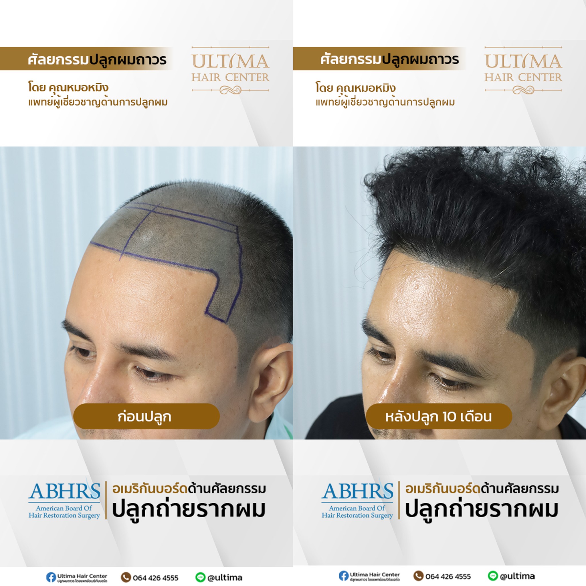 ปลูกผมกี่วันถึงสระผมได้
